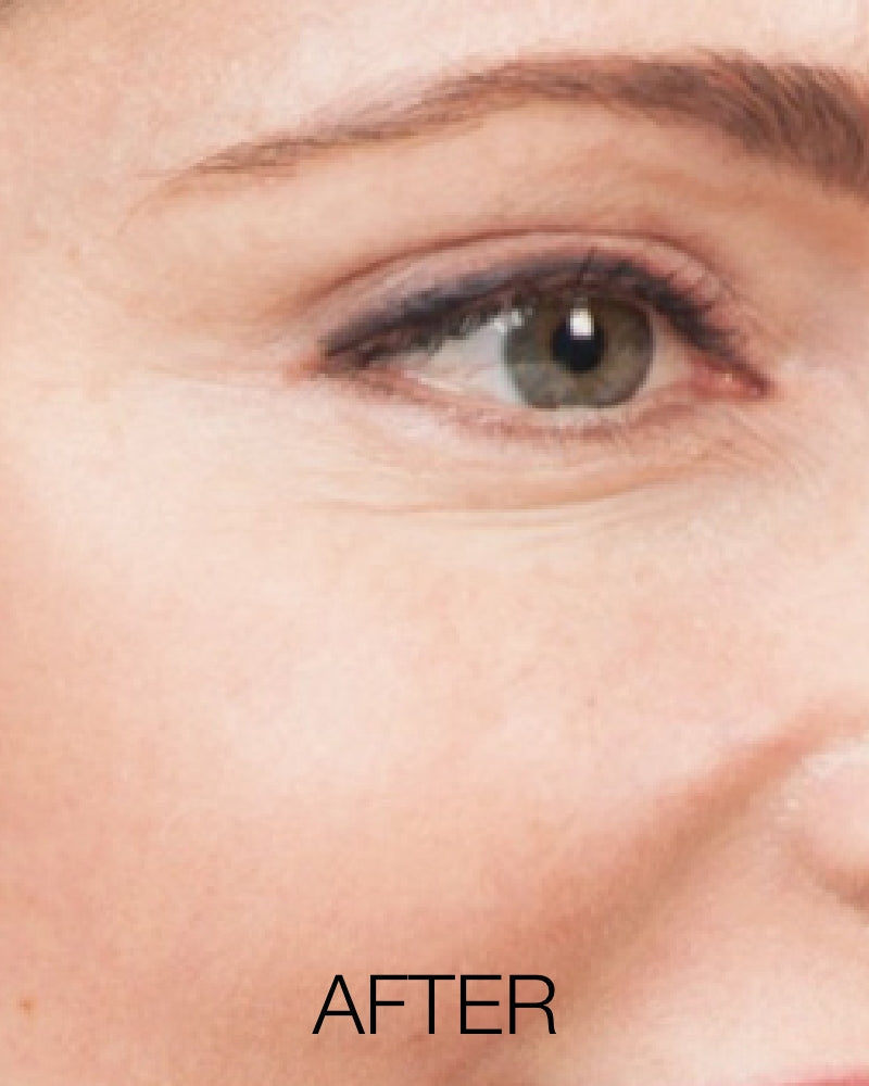 Service Voucher - Botox 20 Units