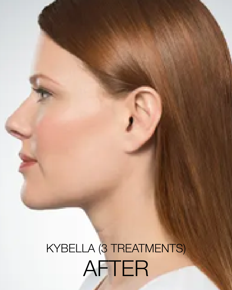Service Voucher - Get The Chin You’ve Always Wanted Package: 2 syringes of Kybella