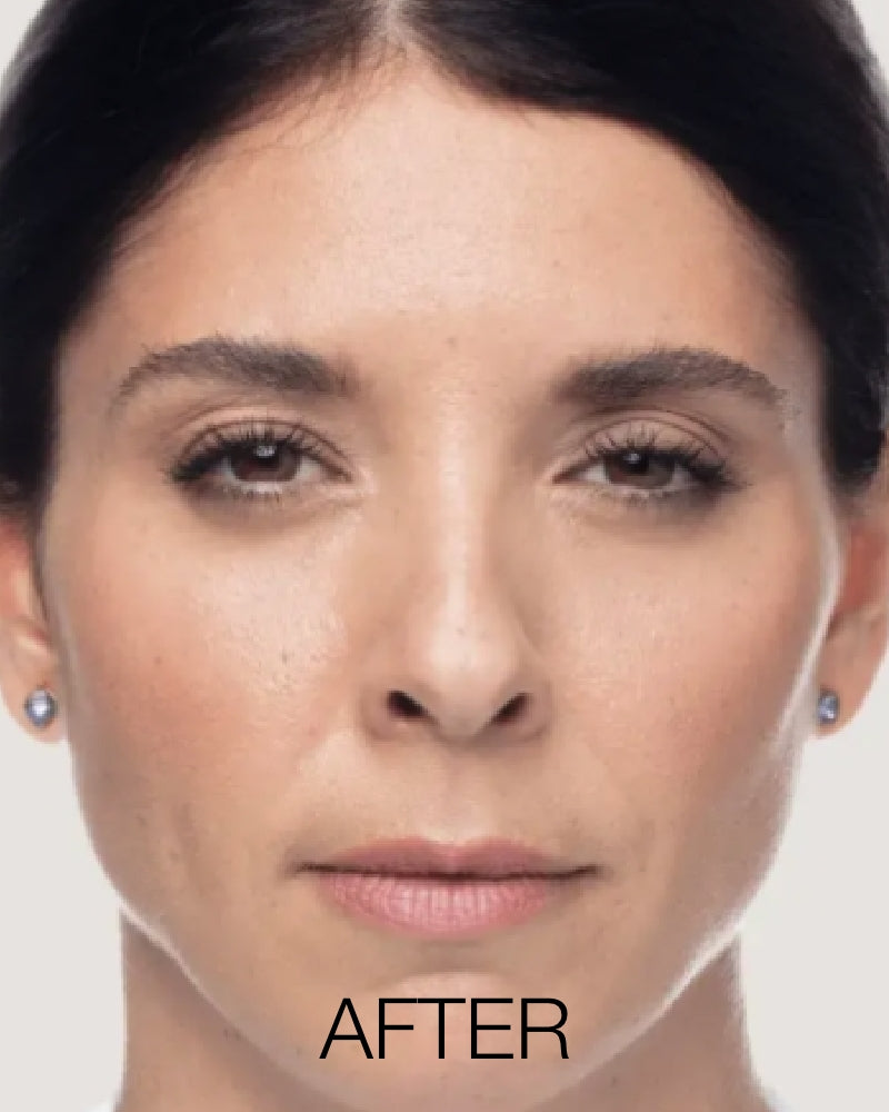 Service Voucher - Dysport 50 Units