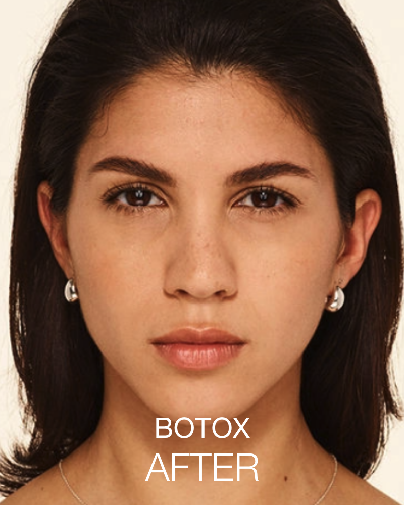 Service Voucher - Signature HydraFacial & 20 Units of Botox