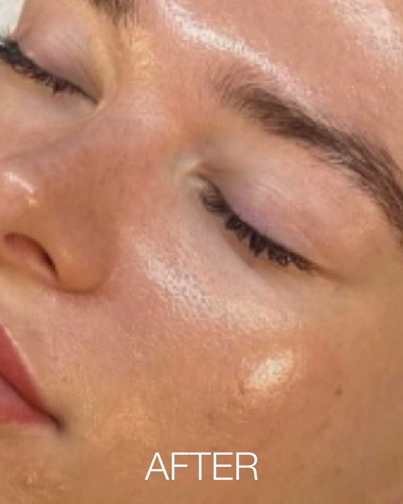 One (1) Signature HydraFacial - Full Face & Neck Combo