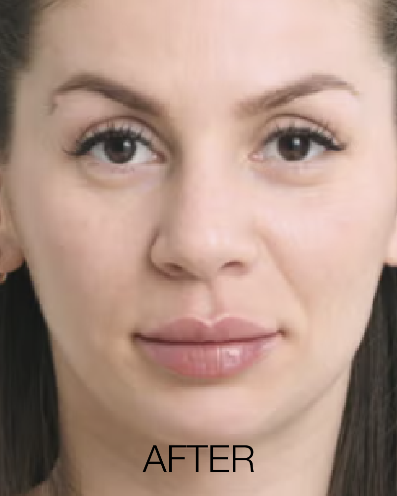 Service Voucher - Kiss Me Package: Lip Filler (Restylane Kysse) with FREE Lip Flip