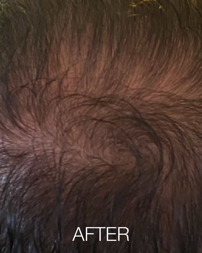 Service Voucher - Three (3) PRP Hair Restoration Treatments