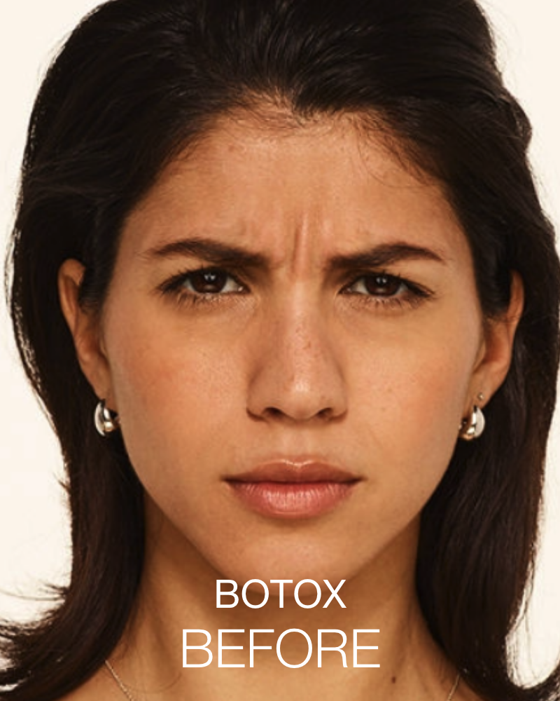 Service Voucher - Self-Love Package: 40 Units of Botox & 2 Syringes of Juvederm Ultra XC