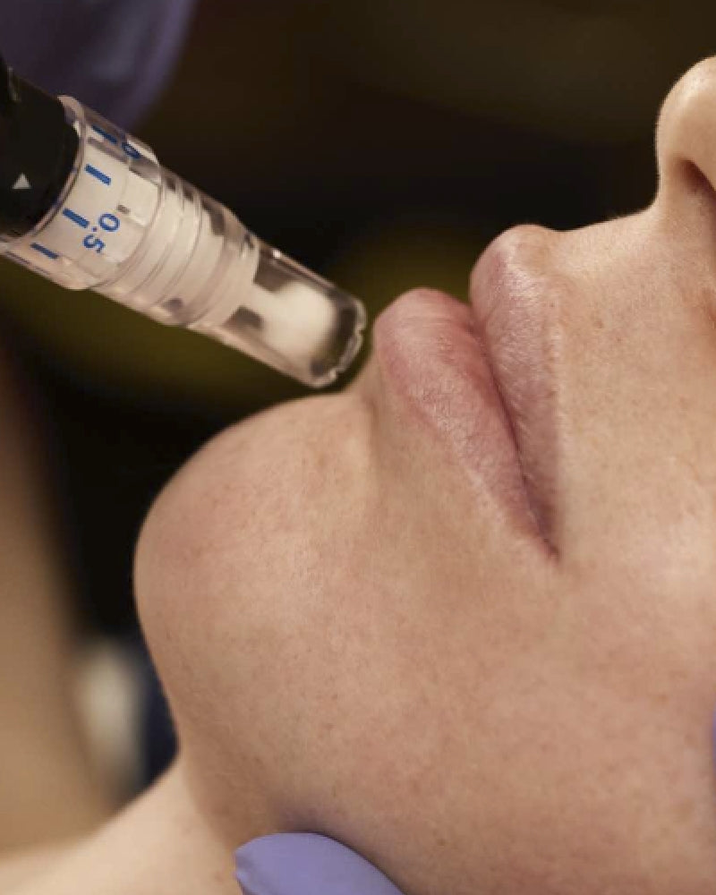 One (1) Session of SkinPen + Stem Cell Treatment - Full Face