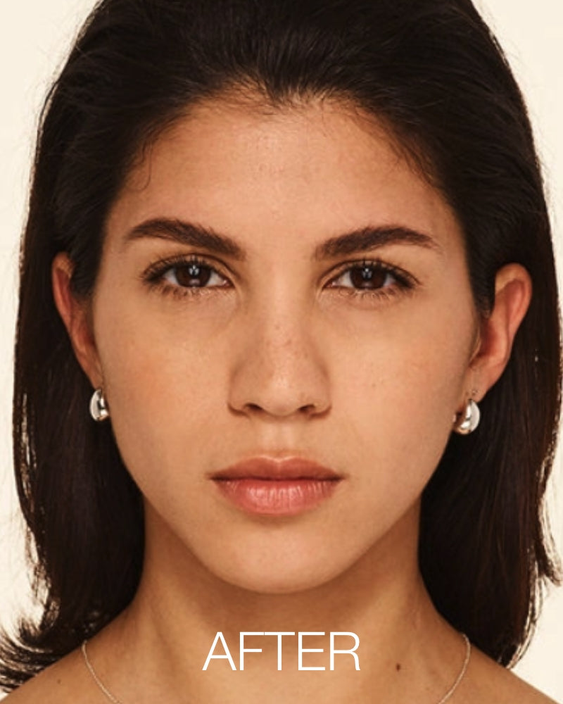 Service Voucher - Botox 20 Units