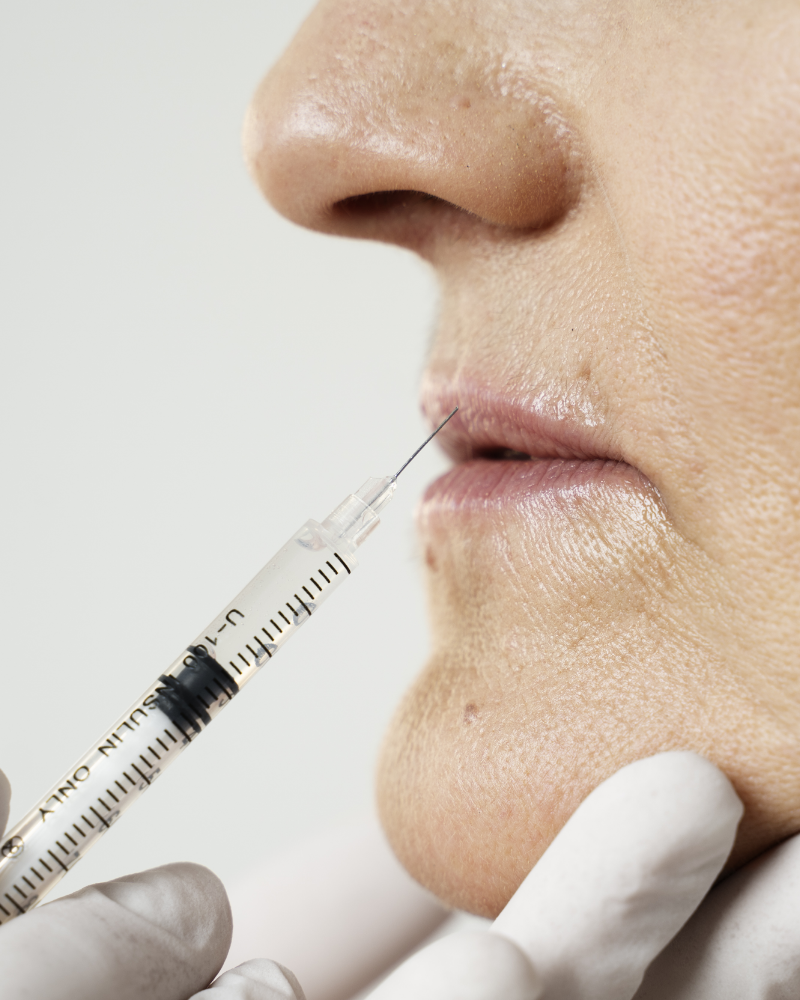 Service Voucher – $100 OFF on Your Choice of Selected Fillers