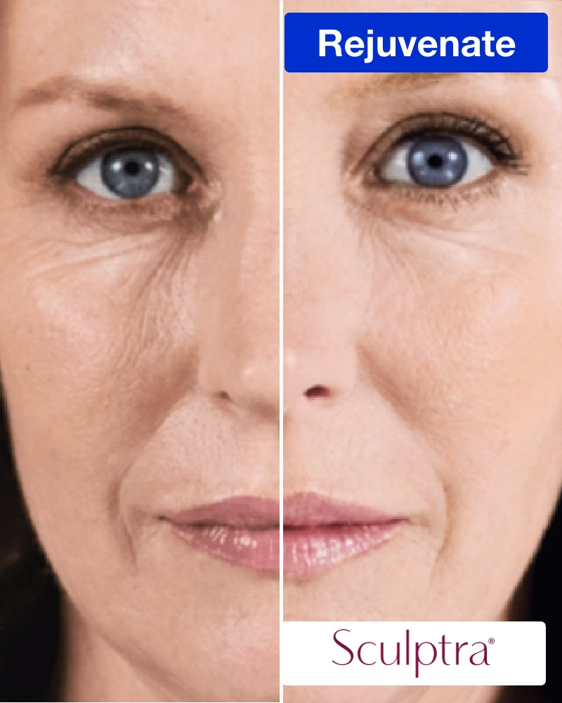 Service Voucher - 2 Vials of Sculptra (Save $100)