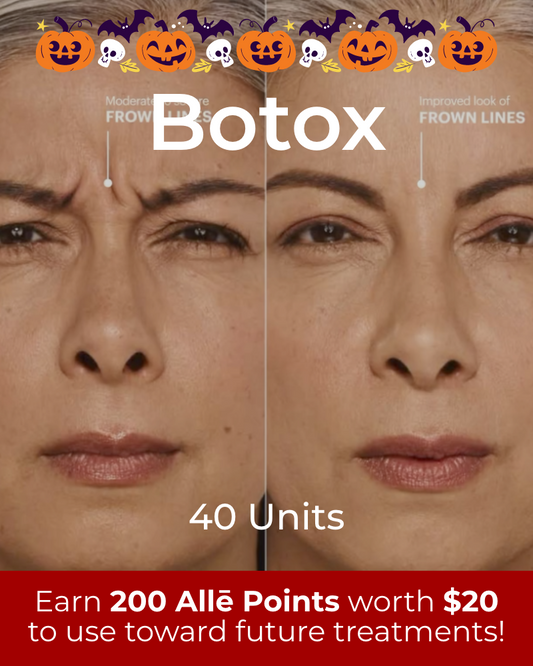 Service Voucher - Botox 40 Units