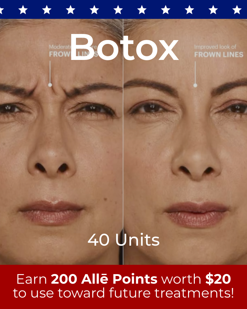 Service Voucher - Botox 40 Units