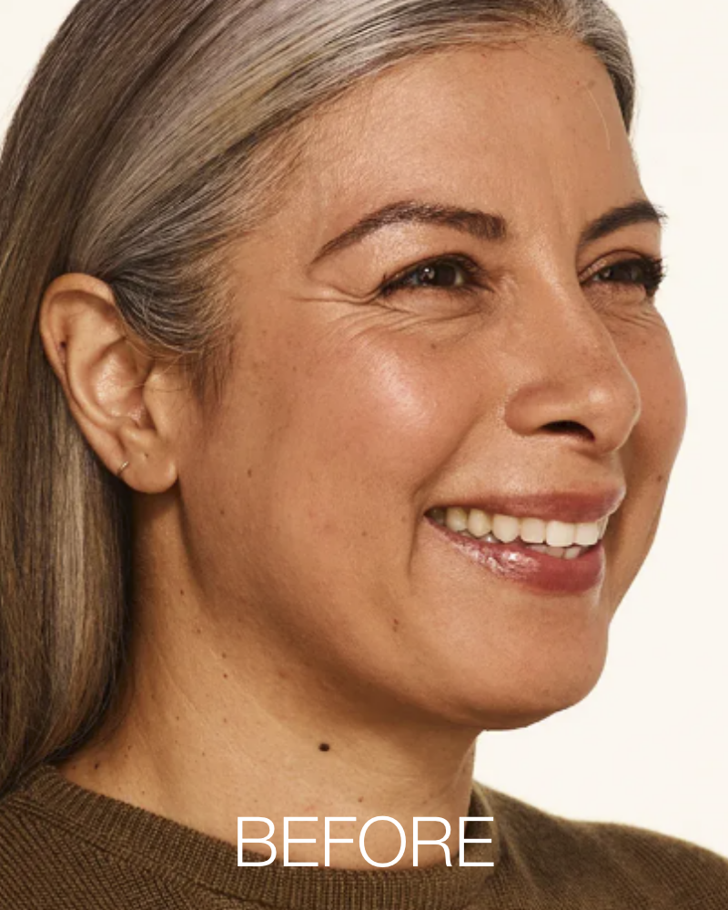 Service Voucher - Botox 40 Units