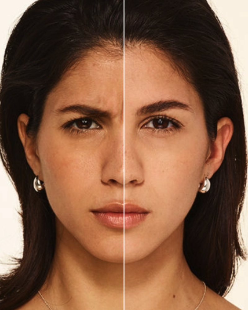 Service Voucher - Botox 40 Units