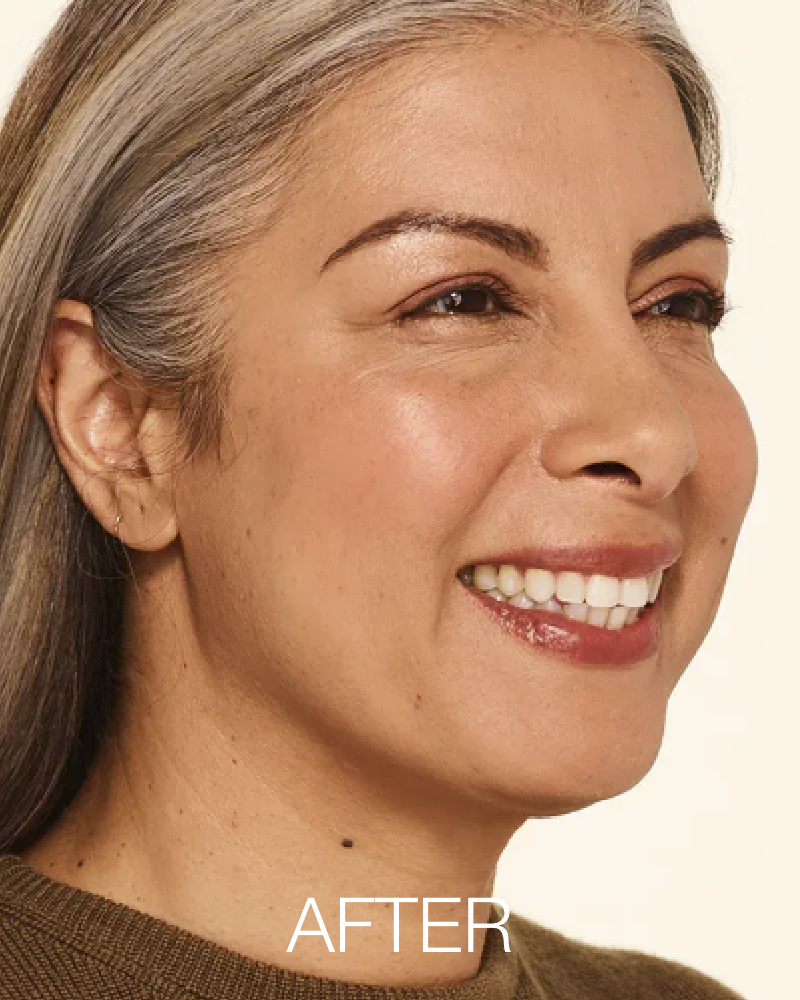 Service Voucher - Botox 40 Units