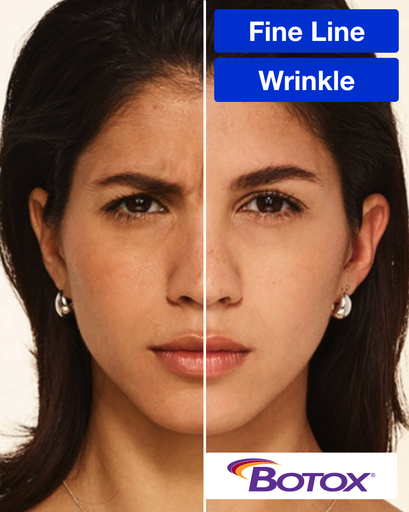 20 units of Botox for $8.49/unit (New Patients Only)