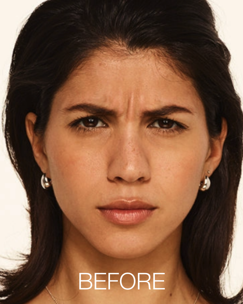 20 units of Botox for $8.49/unit (New Patients Only)