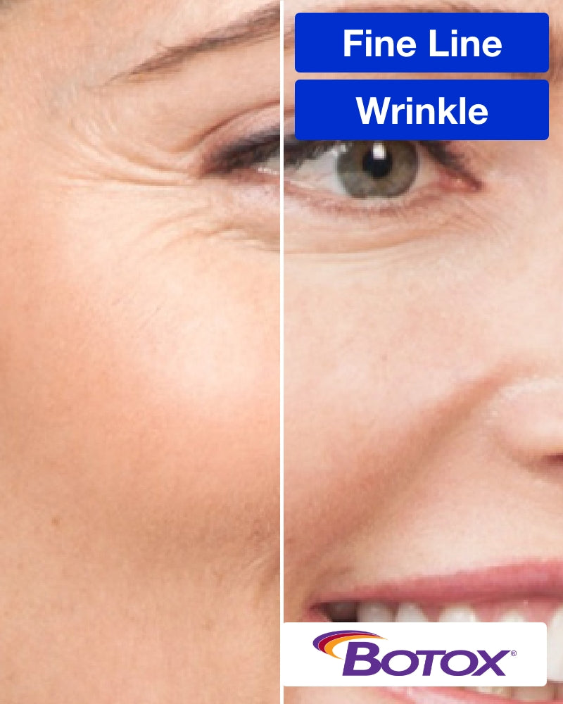 Service Voucher - Botox 20 Units