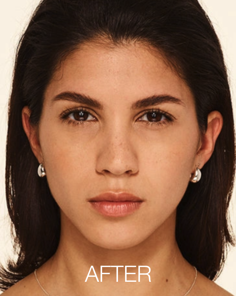 20 units of Botox for $8.49/unit (New Patients Only)