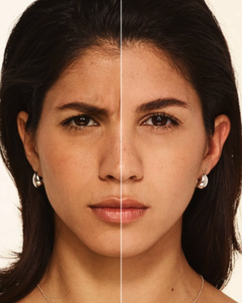 Service Voucher - Botox 20 Units