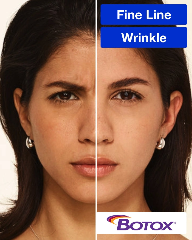 Service Voucher - Botox 40 Units