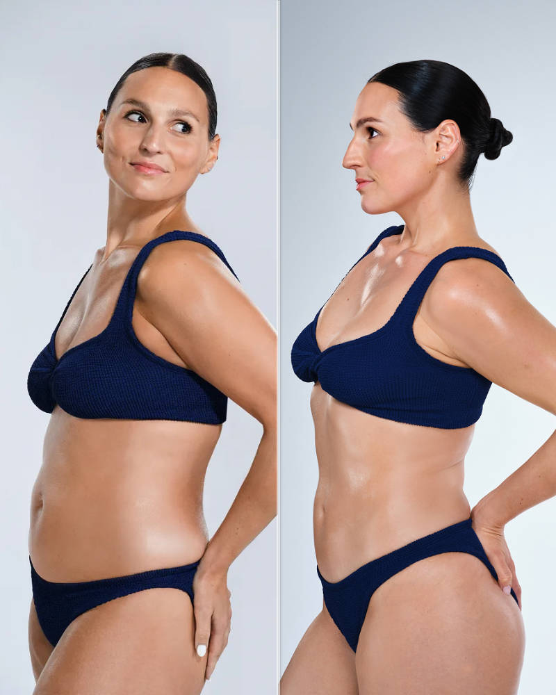 Deposit for 150 Days of CoolSculpting Unlimited Treatments + FREE 20 Units of Botox