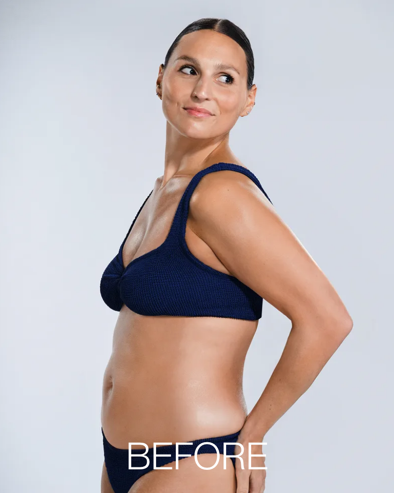 Deposit for 150 Days of CoolSculpting Unlimited Treatments + FREE 20 Units of Botox