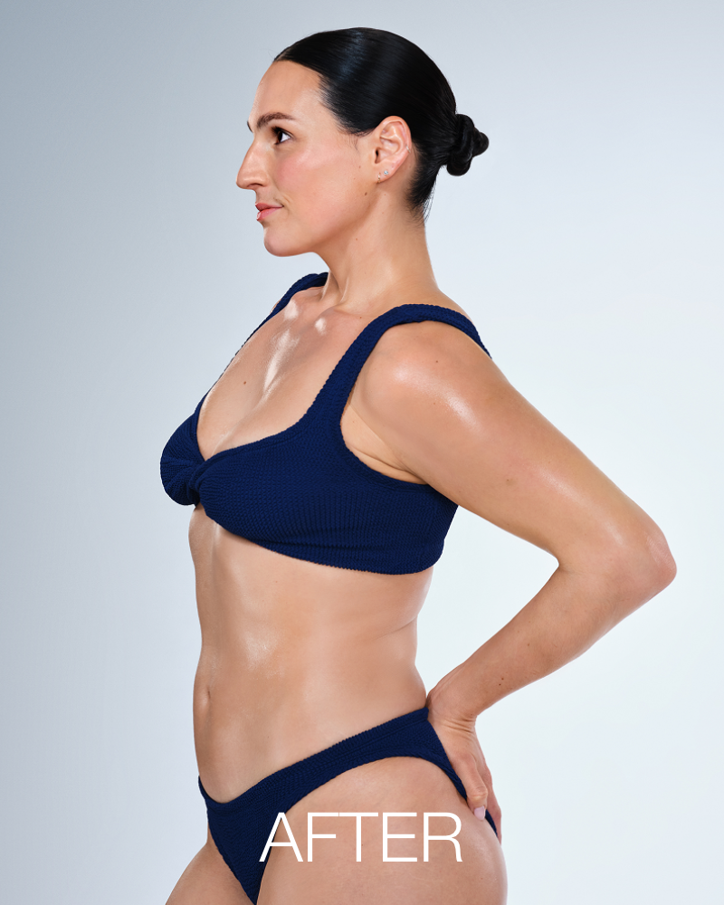 Deposit for 150 Days of CoolSculpting Unlimited Treatments + FREE 20 Units of Botox