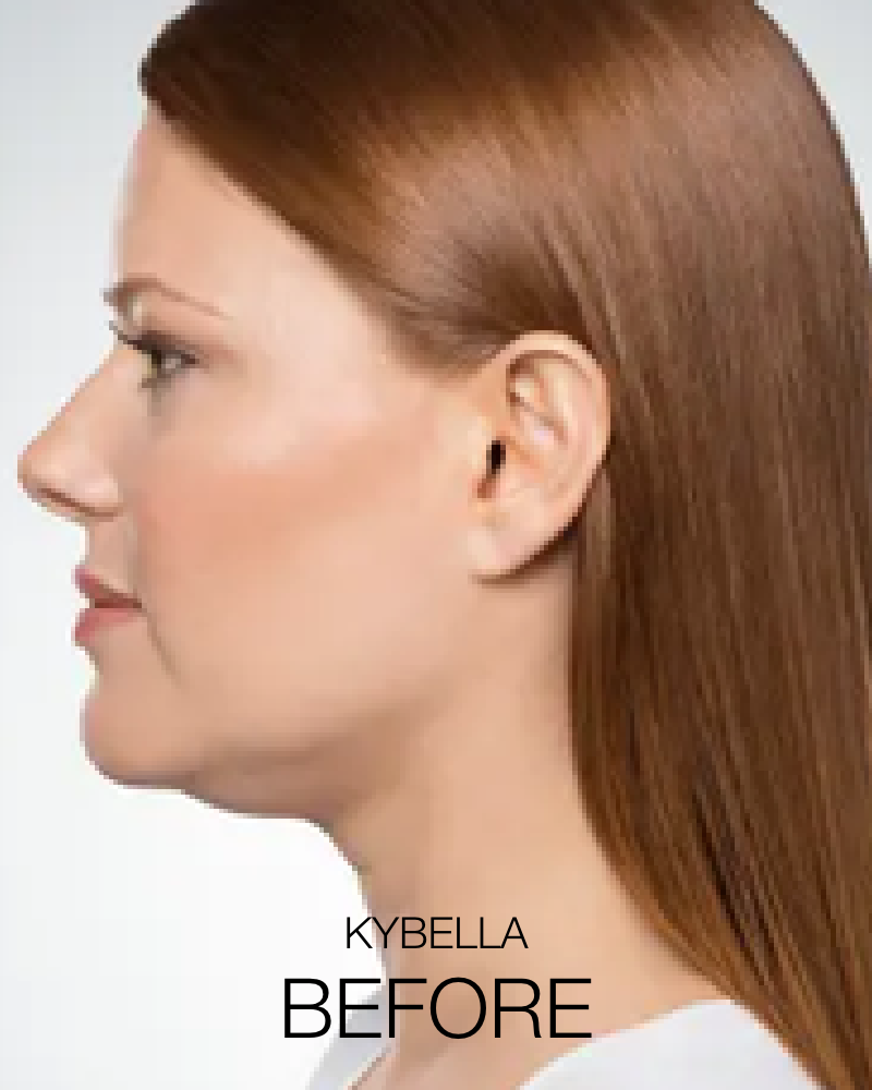 Service Voucher - Get The Chin You’ve Always Wanted Package: 2 syringes of Kybella