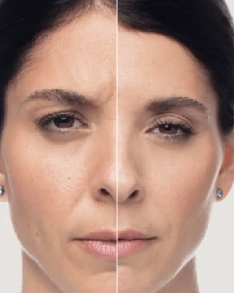 Service Voucher - Dysport 100 Units