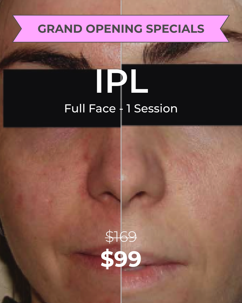 IPL Photofacial – Full Face, One (1) Session