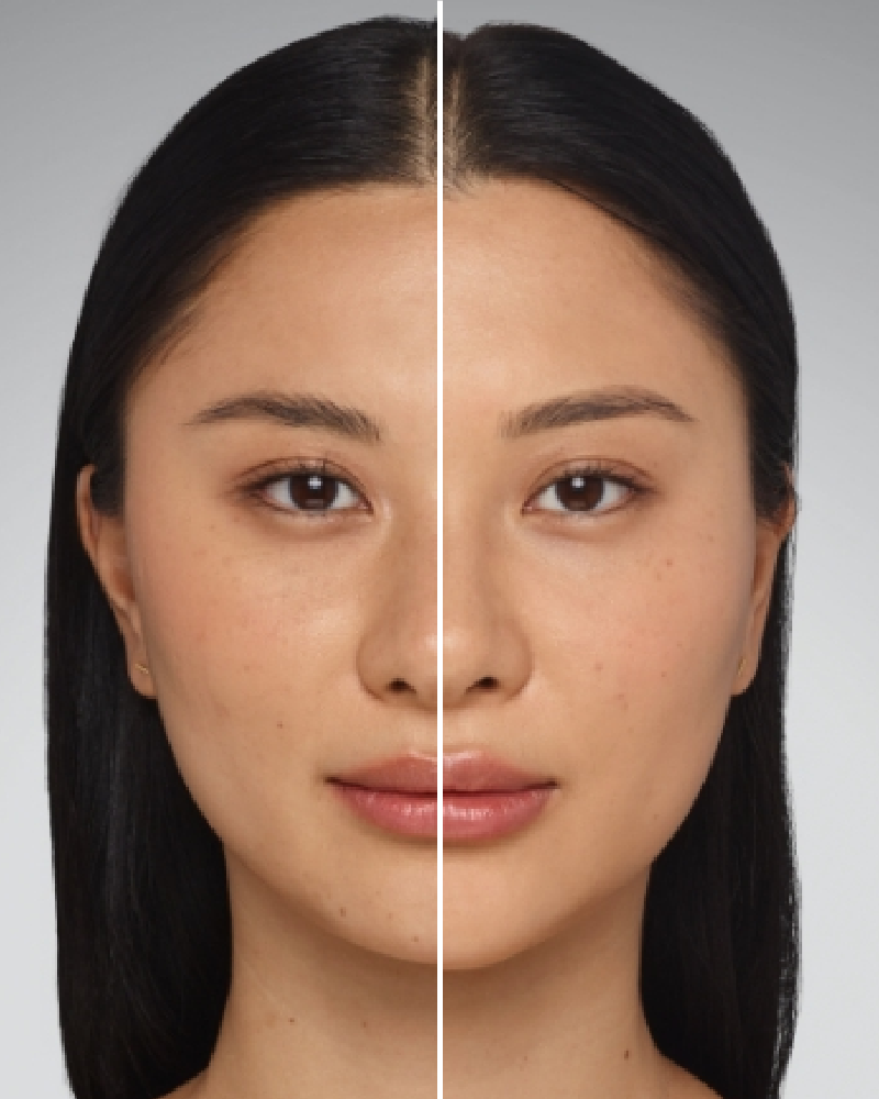 Service Voucher - Juvederm Ultra XC - 1ml Syringe