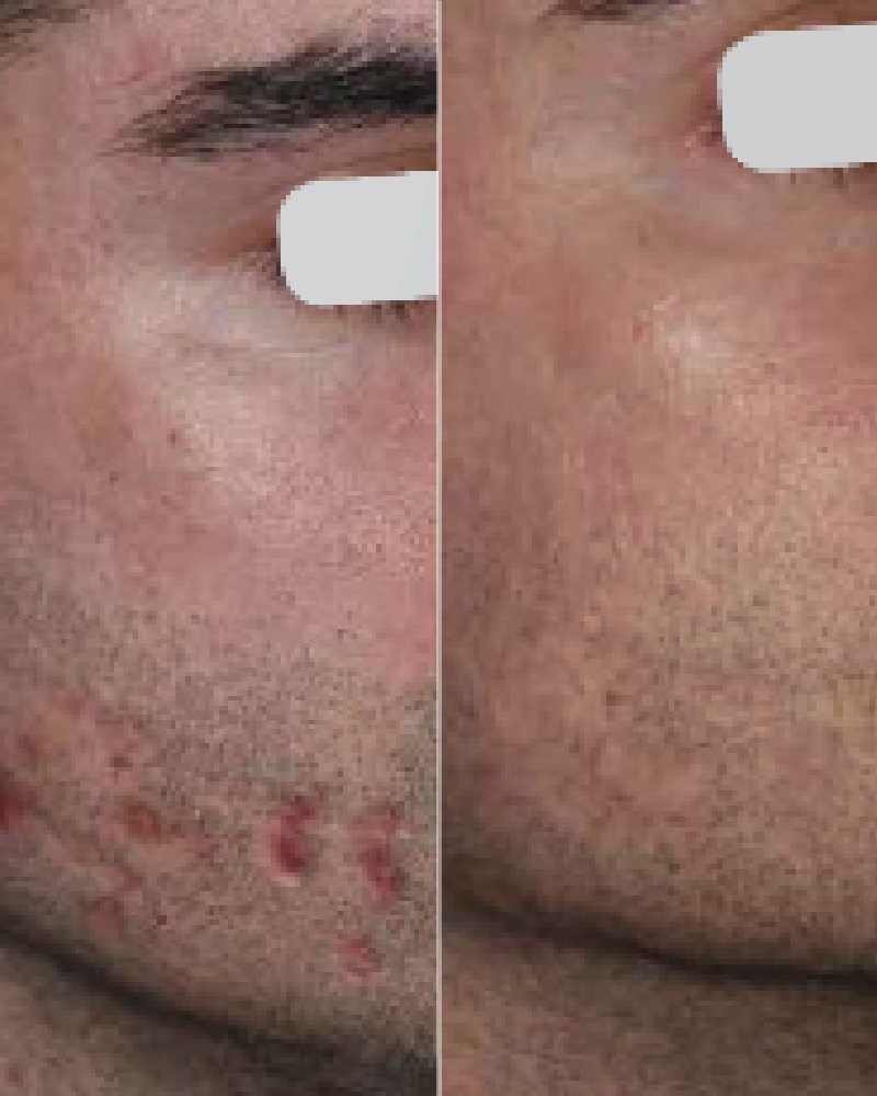 One (1) ResurFX Treatment (Medium Area)