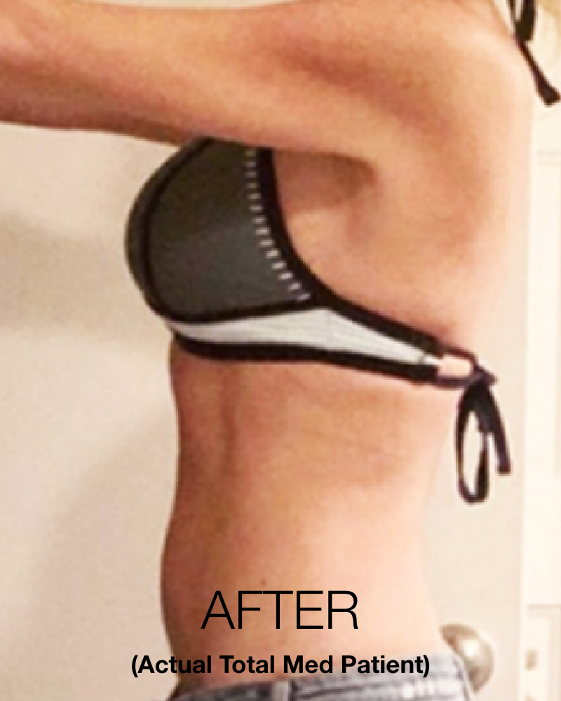 Service Voucher - Semaglutide/GLP-1, 3-month Weight Loss Program + 3 FREE Fat Burner Shots