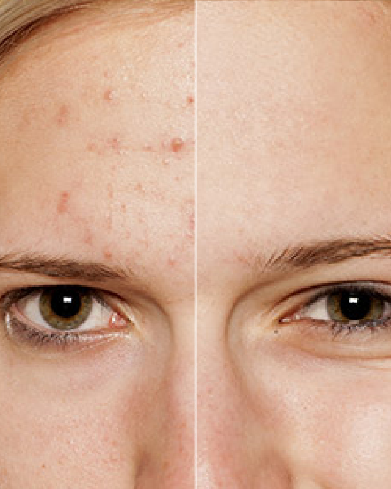 SkinPen – Full Face, Three (3) Sessions