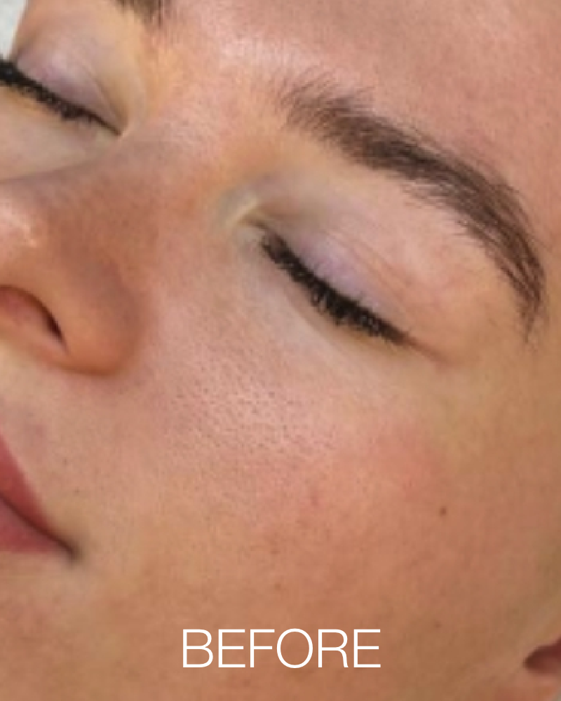 One (1) Signature HydraFacial - Full Face