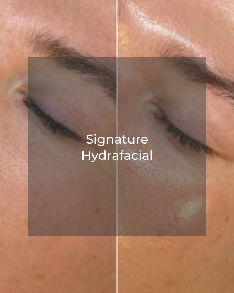 Service Voucher - Signature HydraFacial & 20 Units of Botox