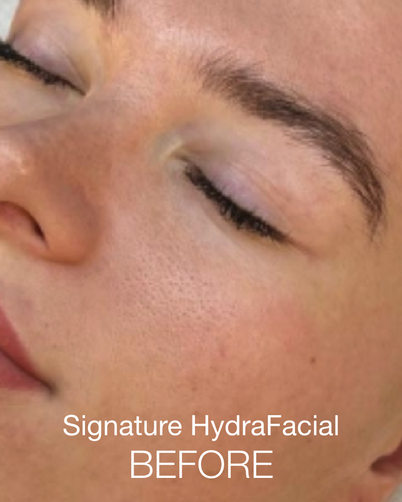 Service Voucher - Signature HydraFacial & 20 Units of Botox