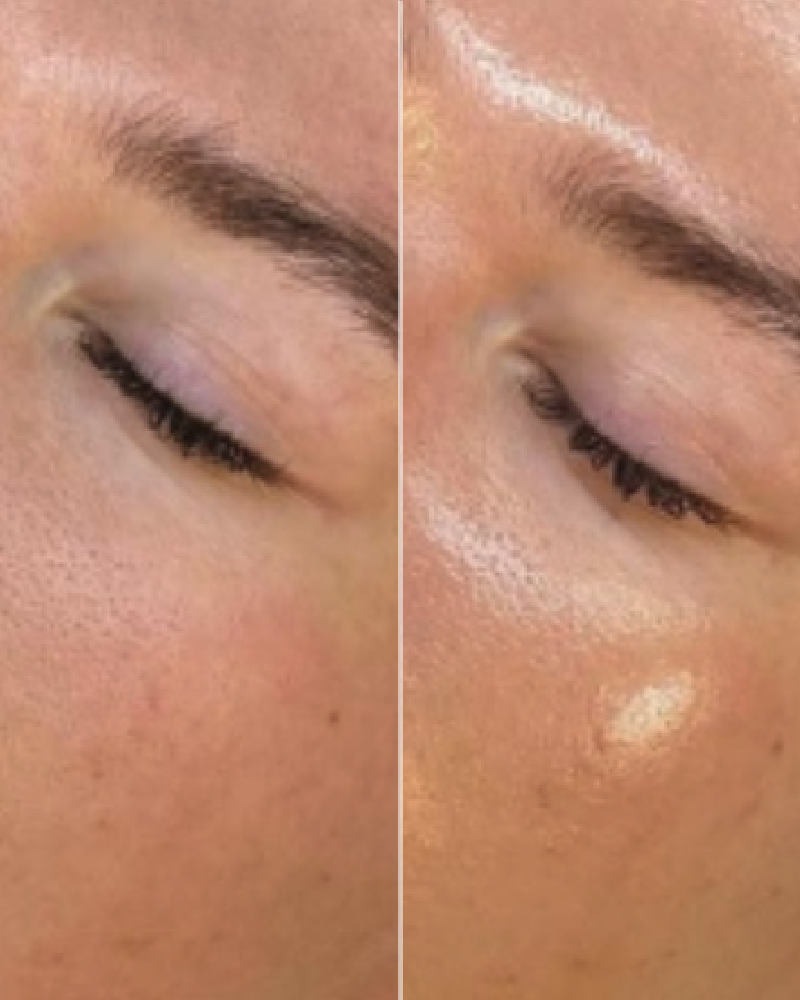 One (1) Signature HydraFacial - Full Face