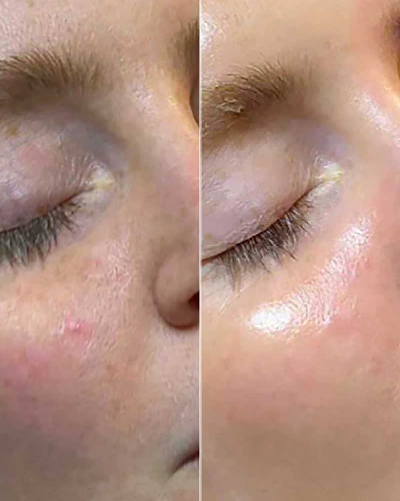 One (1) Signature HydraFacial - Full Face