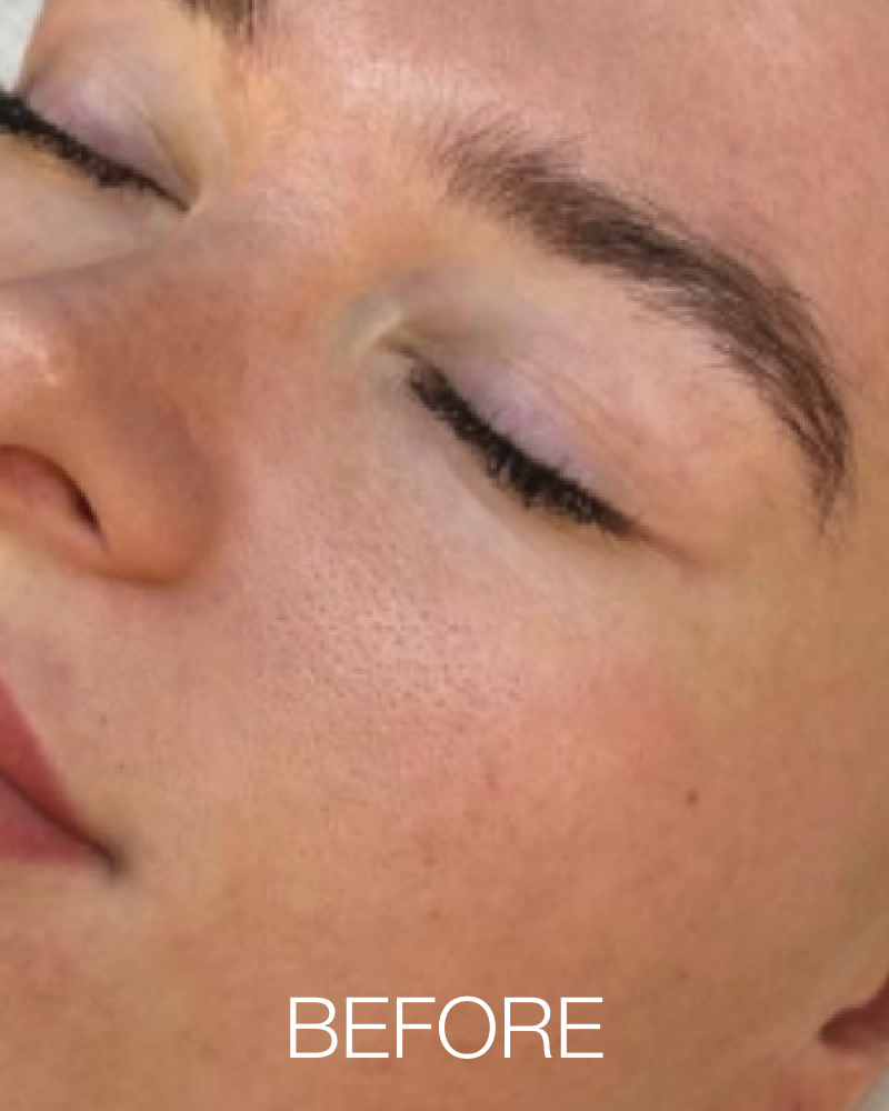 One (1) Signature HydraFacial - Full Face