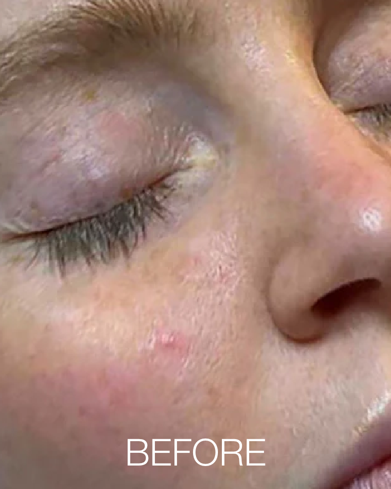One (1) Signature HydraFacial - Full Face