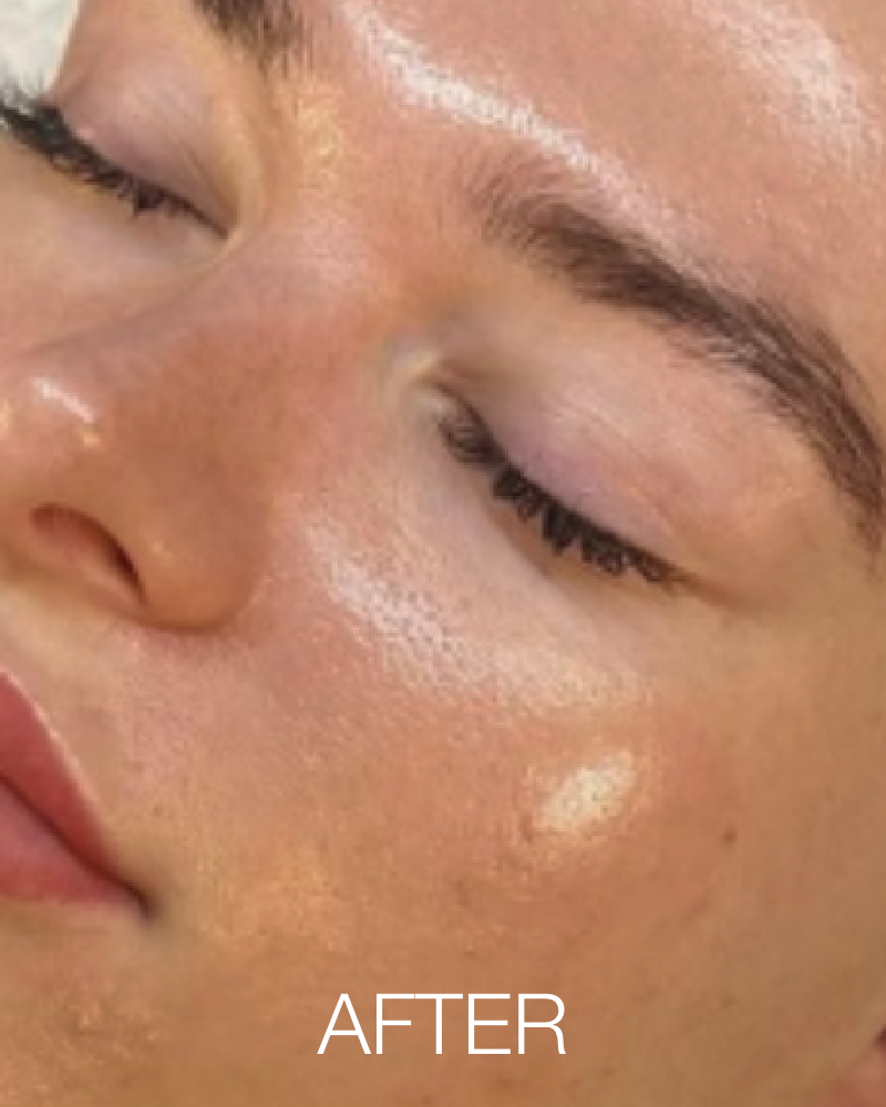 One (1) Signature HydraFacial - Full Face
