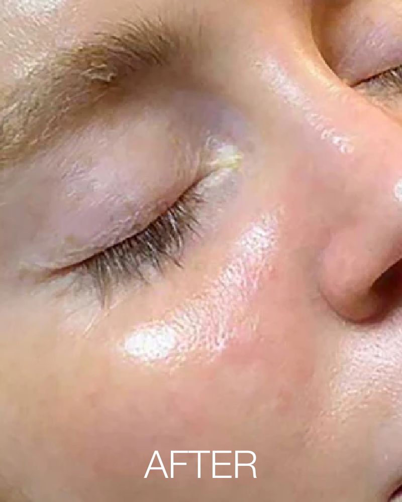 One (1) Signature HydraFacial - Full Face