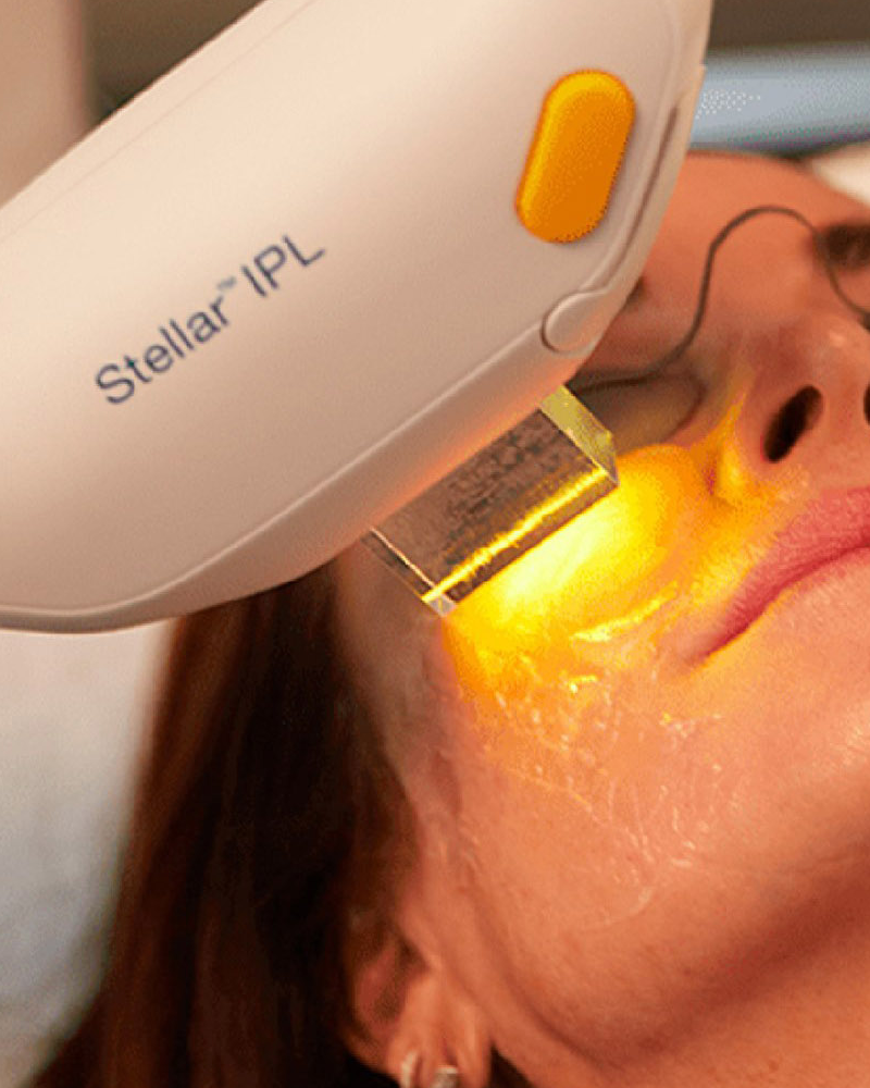 One (1) Signature HydraFacial with IPL - Full Face