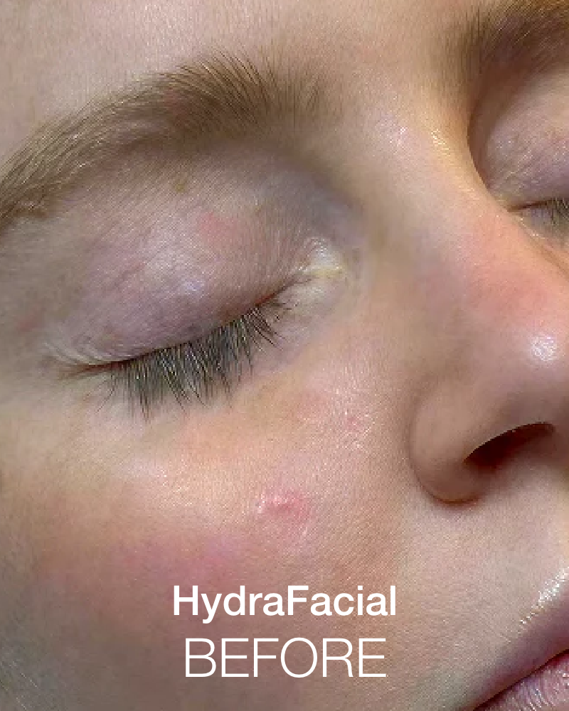 Ultimate Glow Aesthetics Package - One (1) Dermaplanning, HydraFacial & IPL