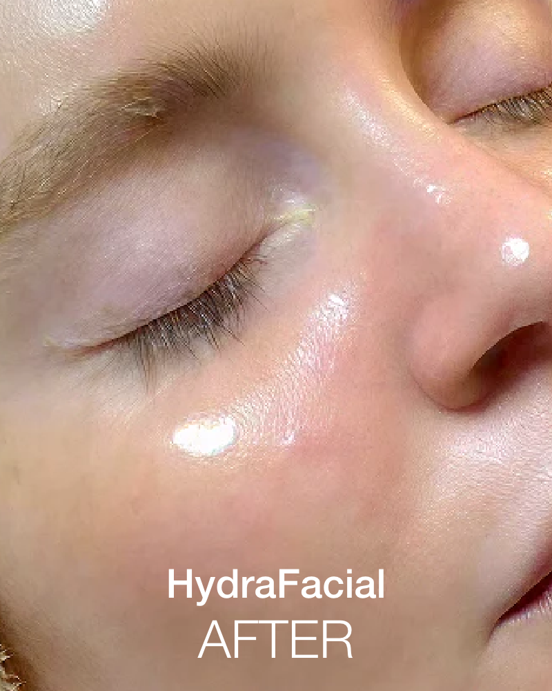 Ultimate Glow Aesthetics Package - One (1) Dermaplanning, HydraFacial & IPL
