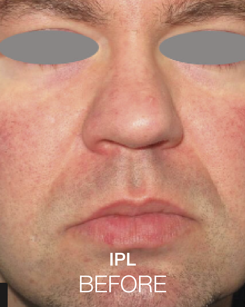 One (1) Signature HydraFacial with IPL - Full Face