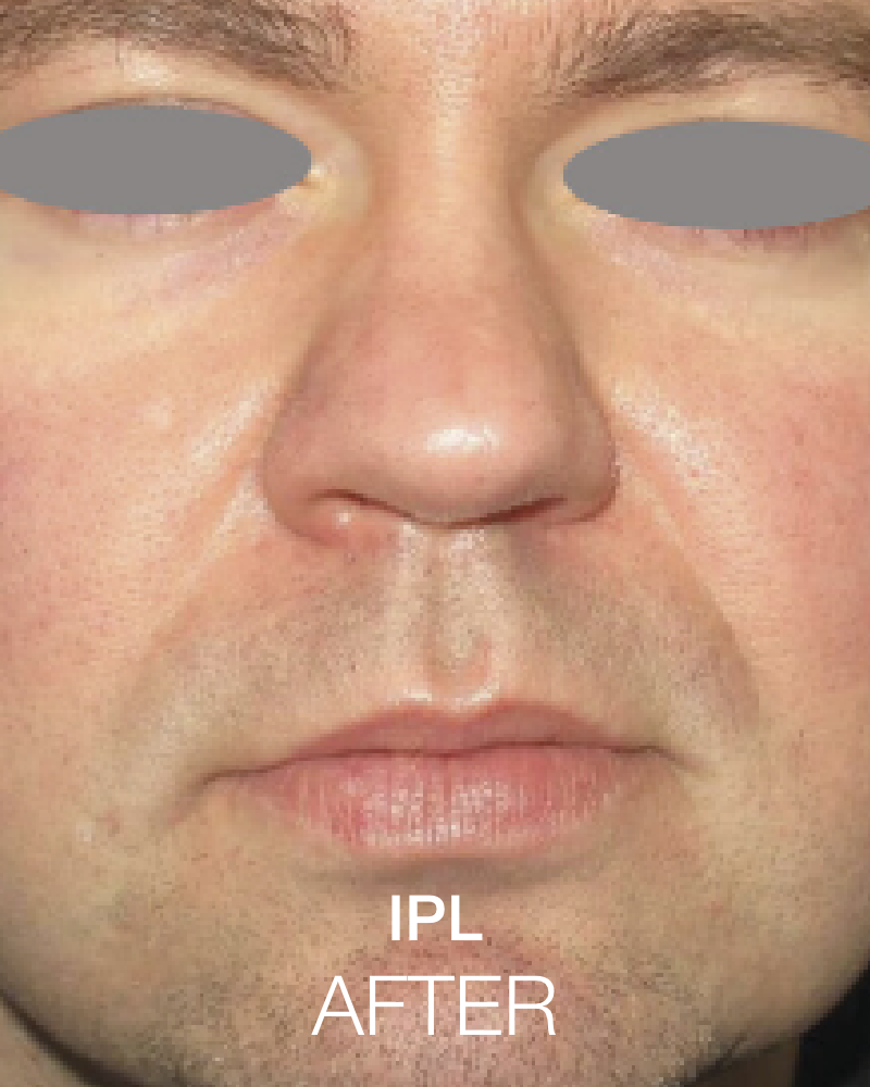 One (1) Signature HydraFacial with IPL - Full Face