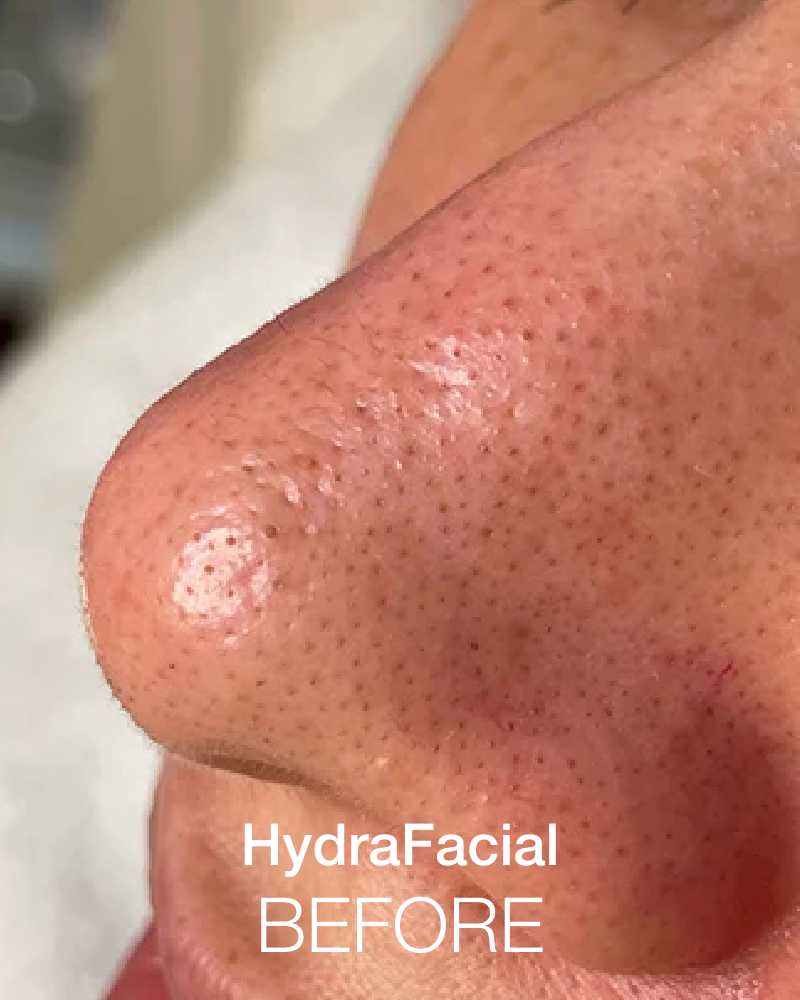 One (1) Signature HydraFacial with IPL - Full Face