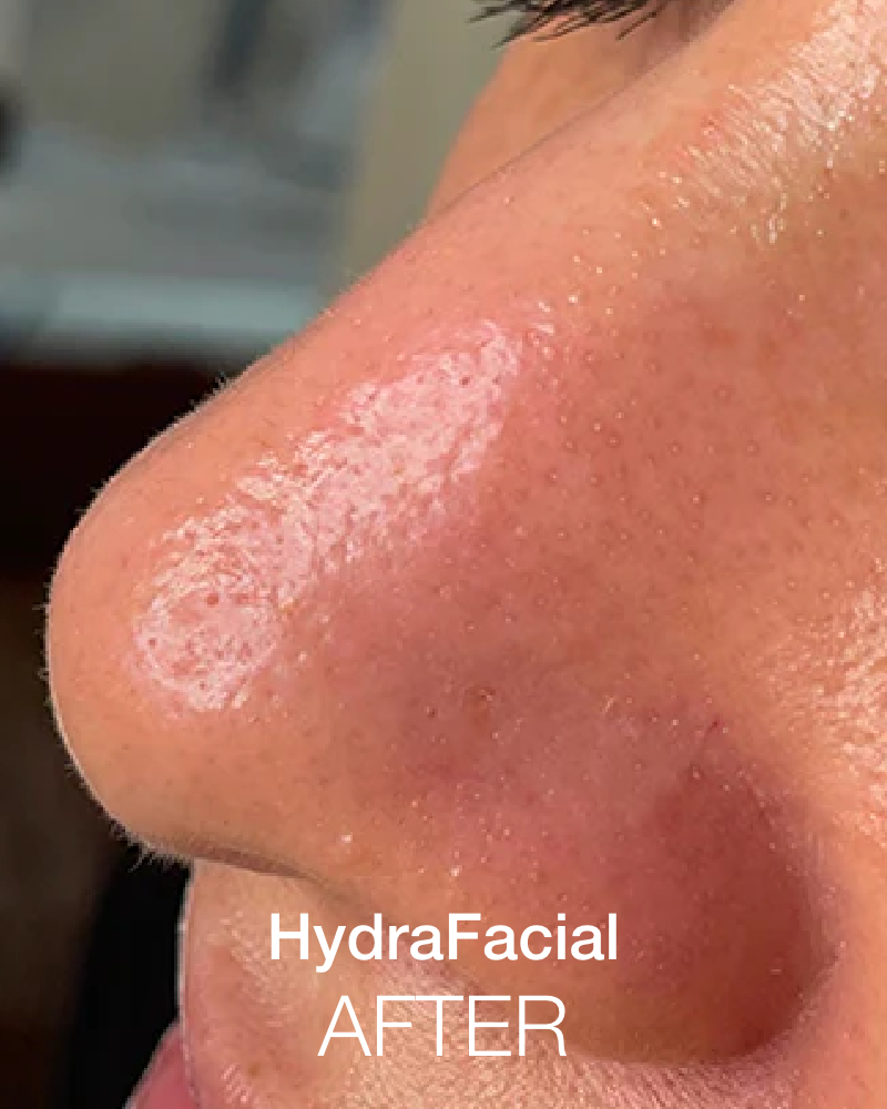 One (1) Signature HydraFacial with IPL - Full Face