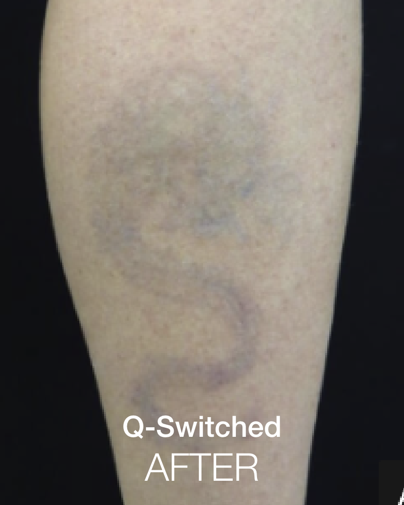 One (1) Signature HydraFacial with Q-Switched - Full Face